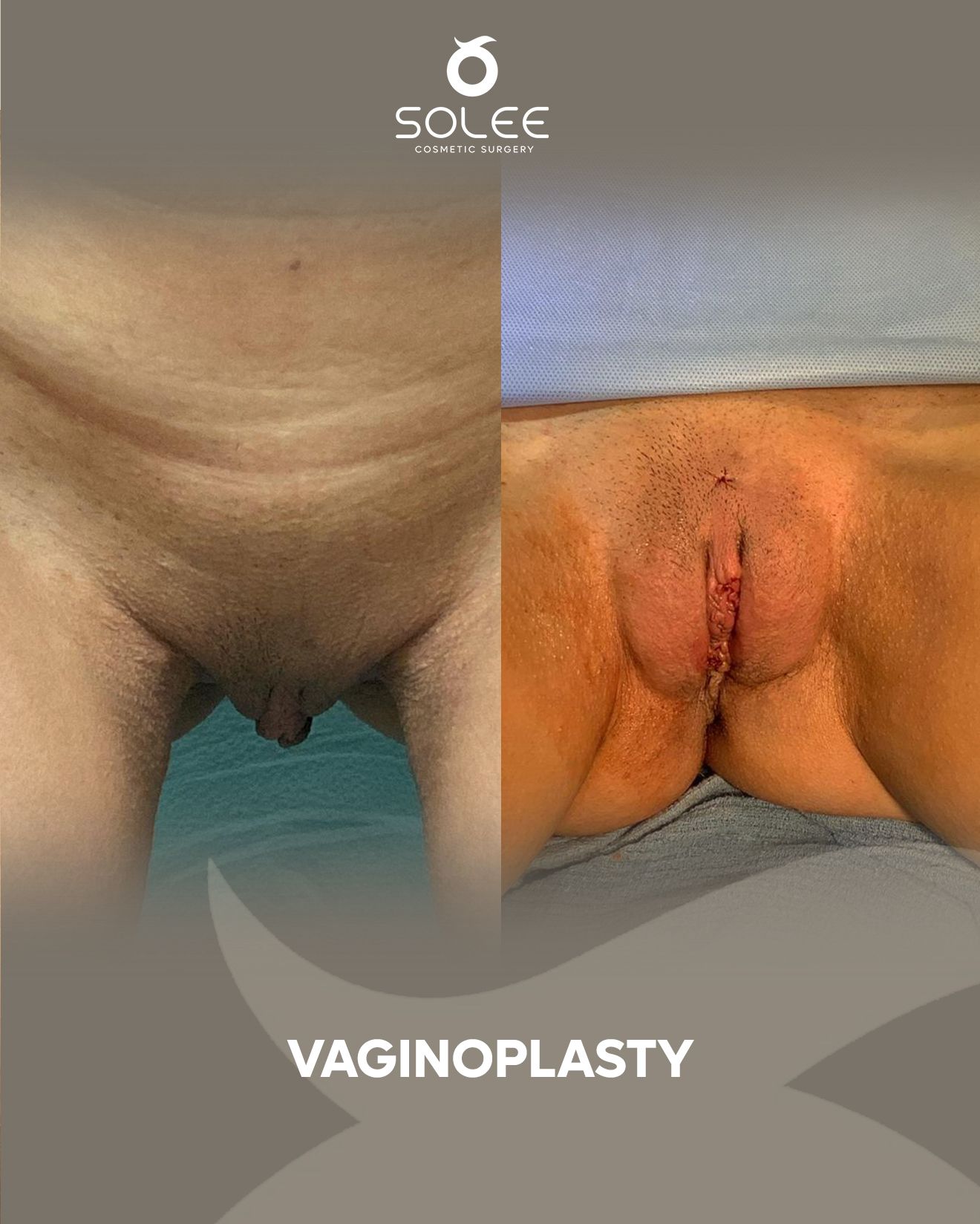Labiaplasty before and after #3