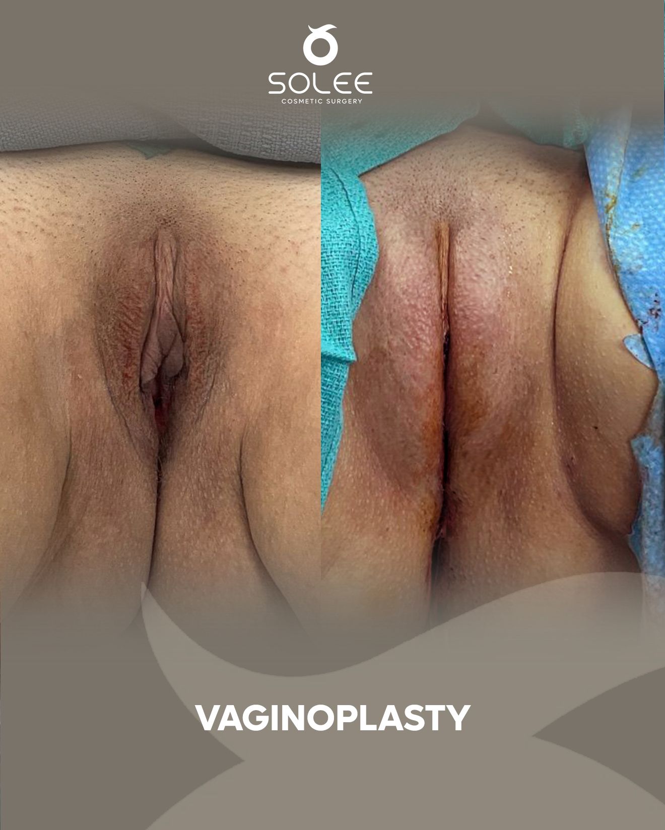 Labiaplasty before and after #5