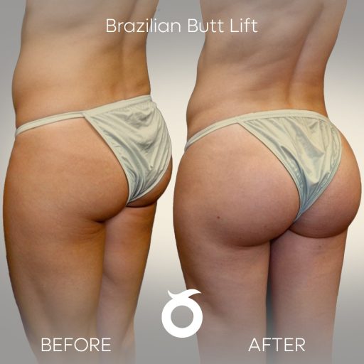brazillian-but-lift-solee