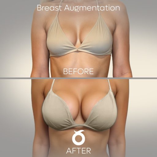 breast-augmentation