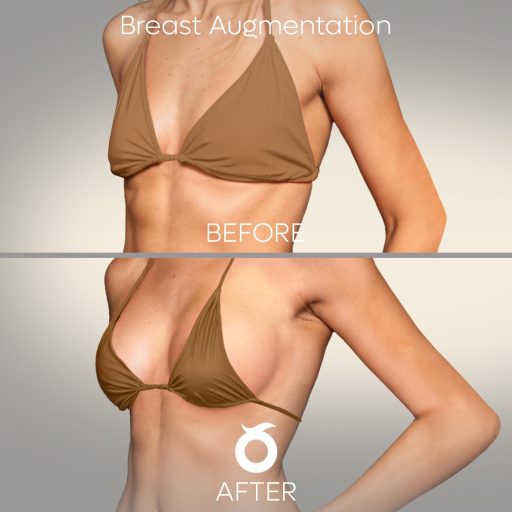 breast-augmentation-solee
