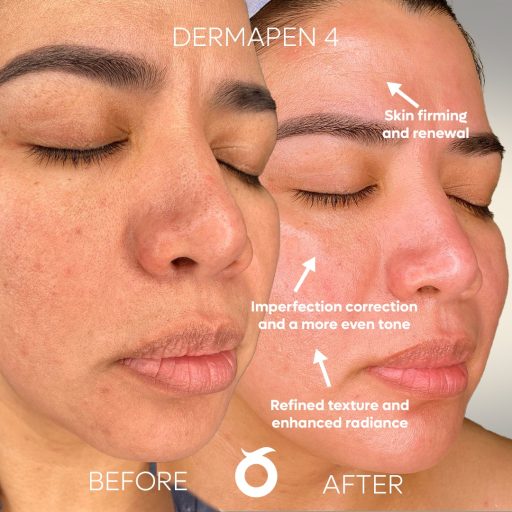 dermapen4-solee