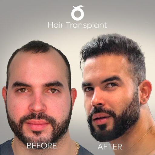 hair-transplant-solee-cosmetic-surgery