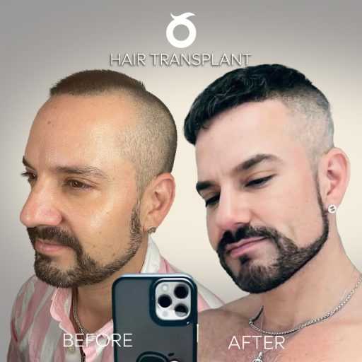 hair-transplant-solee