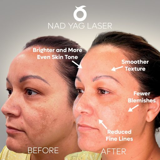 nad-yac-laser-solee